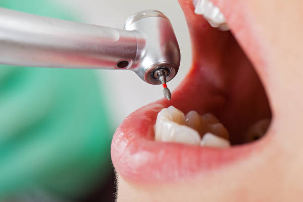 Best Walk-In Emergency Dentist in Squirrel Mountain Valley, CA